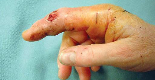 A swollen, red finger after a cat bite showing small puncture wounds