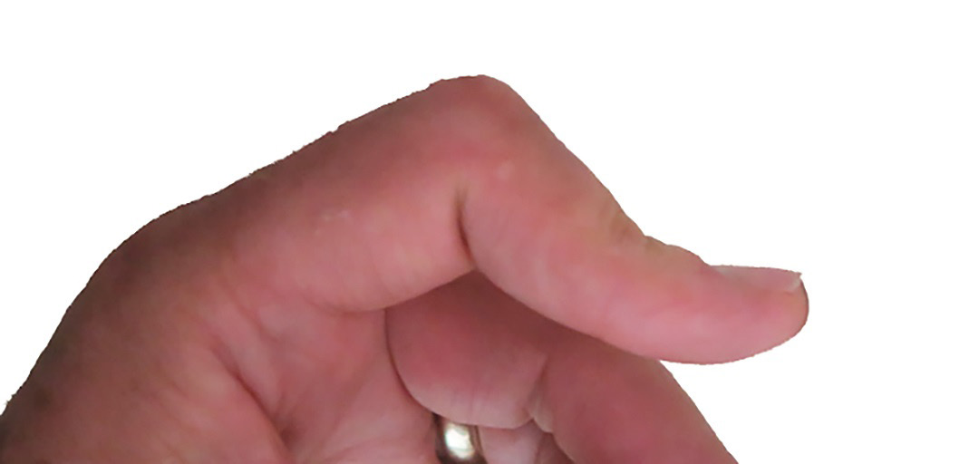 A finger with the middle joint bent down and the fingertip hyperextended, the classic boutonnière position