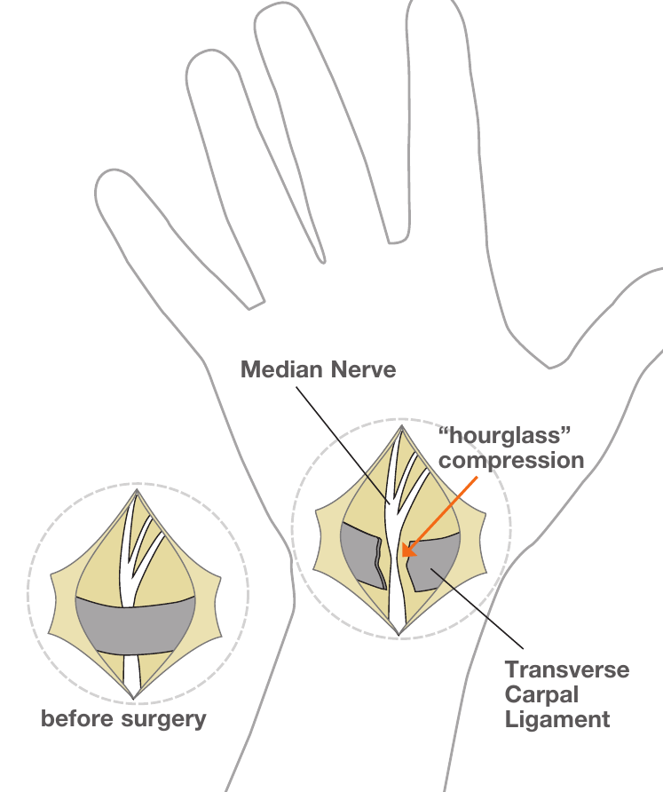 The median nerve shown with hourglass compression under the transverse carpal ligament before carpal tunnel release surgery