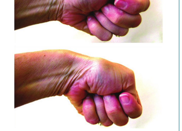 The Finkelstein test, performed by making a fist with the thumb tucked inside the fingers and bending the wrist toward the small finger
