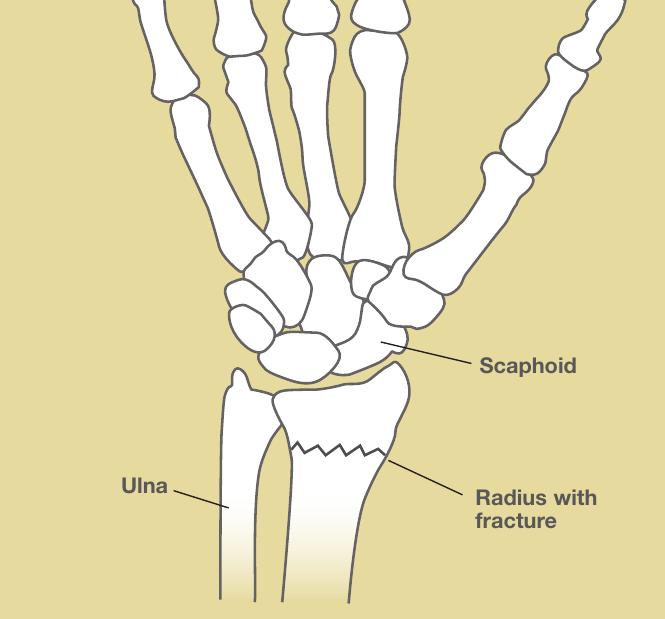 Illustration of a wrist showing a fracture line across the distal radius just above the small wrist bones