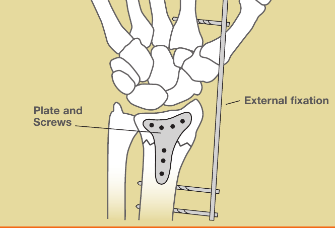 Illustration of a distal radius fracture fixed with a plate and screws, shown alongside an external fixation option