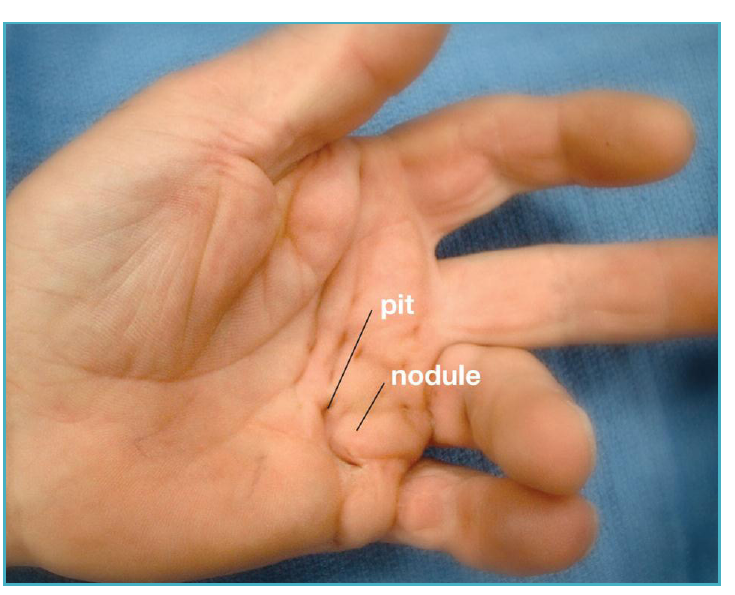 Palm of a hand showing a firm nodule and pit in the skin at the base of the ring finger, typical early signs of Dupuytren's