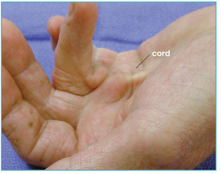 Palm showing a rope-like Dupuytren's cord running from the palm into the ring finger