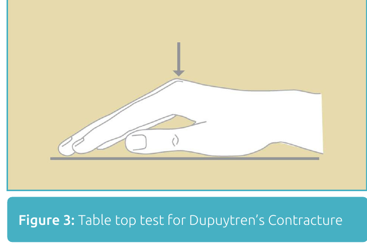 Hand resting with the palm down on a tabletop, the tabletop test for Dupuytren's contracture
