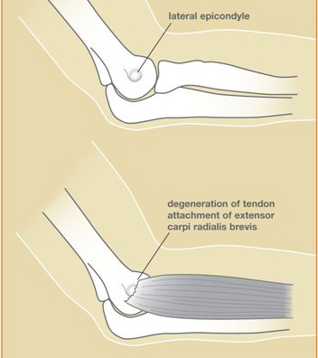 Side view of the lateral elbow showing irritation of the extensor tendon at the lateral epicondyle (tennis elbow)