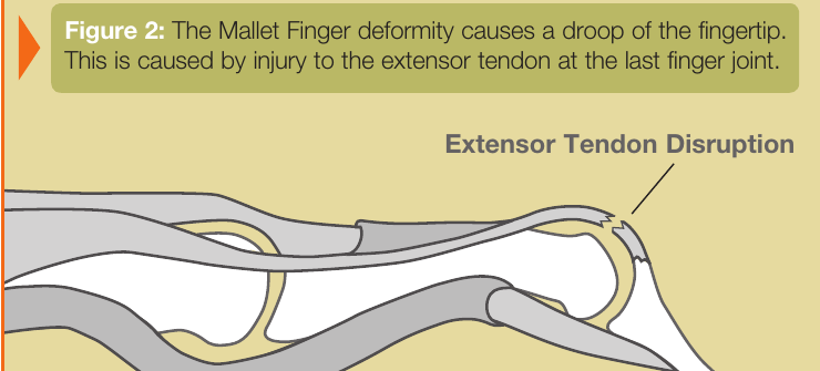 Side view of a fingertip showing an extensor tendon disruption at the last joint, known as mallet finger