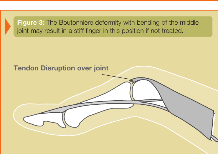 Side view of a finger with boutonnière deformity showing tendon disruption over the middle joint