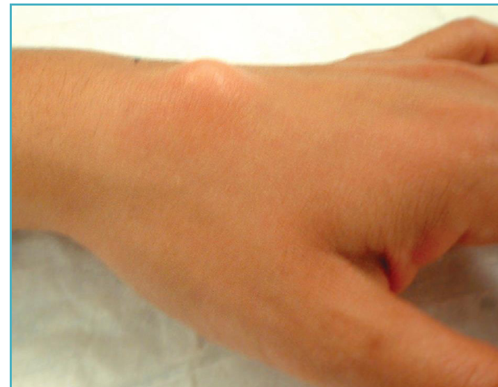 Photo of a wrist with a dorsal ganglion cyst, a smooth round bump on the back of the wrist