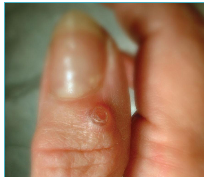 Photo of a finger with a small mucous cyst at the base of the fingernail