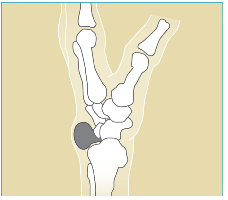 Illustration of the wrist showing a ganglion cyst arising from a small joint between the carpal bones