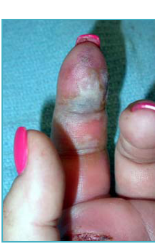 Photo of a finger with a felon infection at the fingertip, showing marked swelling and skin discoloration