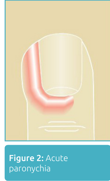 Illustration of a finger nail with redness and swelling along the nail fold, acute paronychia