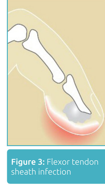 Illustration of flexor tendon sheath infection with redness and swelling tracking along the finger