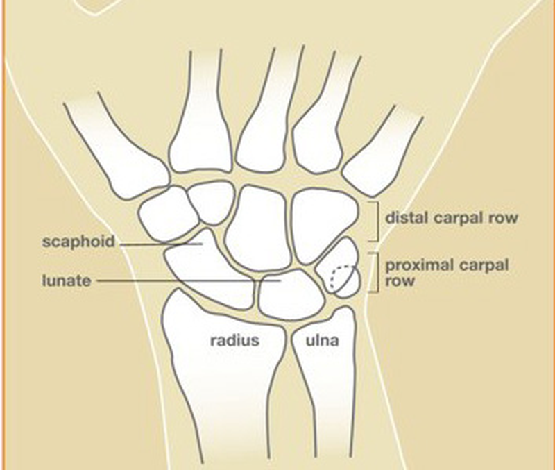 Illustration of the normal wrist showing the eight carpal bones, with the lunate labeled in the center of the proximal row