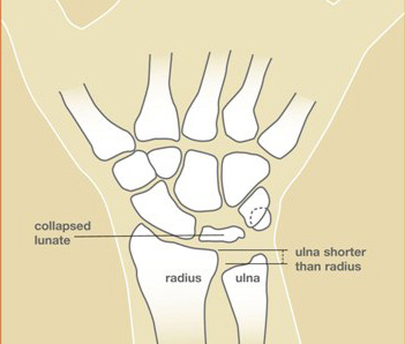 Illustration of a wrist with Kienböck's disease showing a collapsed lunate and the ulna shorter than the radius