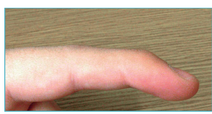 Finger with a mallet deformity, the fingertip drooping and unable to straighten