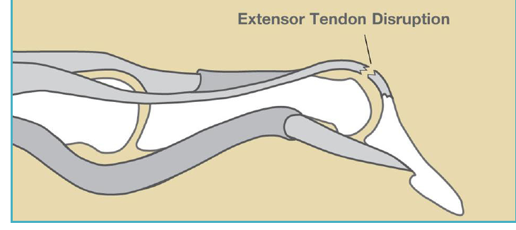 Illustration of the extensor tendon pulled away from the distal phalanx at the tip of the finger