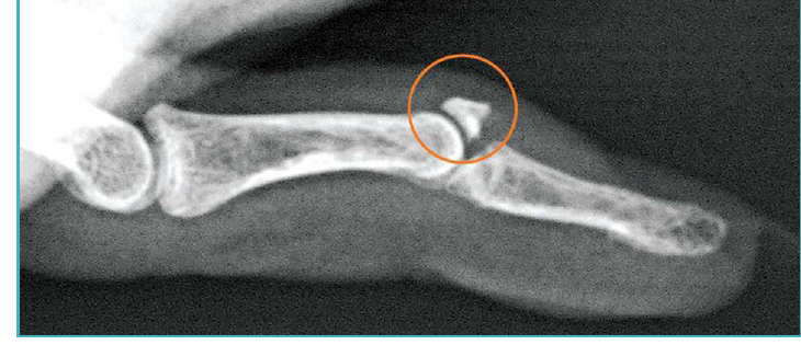 X-ray of a finger with a small bone fragment pulled off the back of the distal phalanx, a bony mallet injury