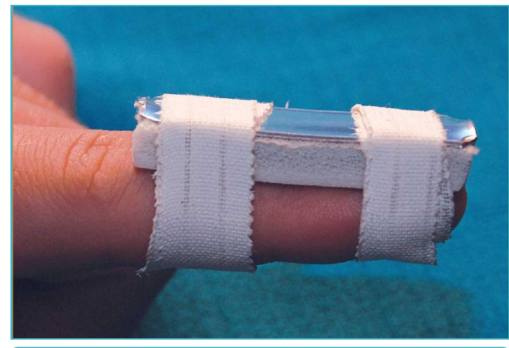 Fingertip held in a small splint that keeps the tip straight