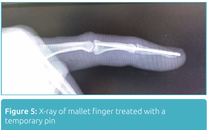 X-ray of a mallet finger stabilized with a single small pin crossing the end joint