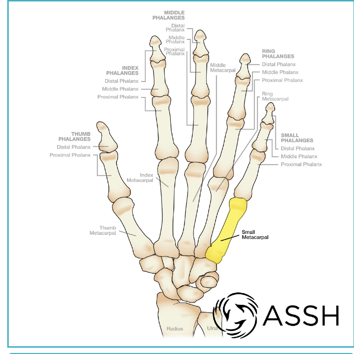 Illustration of the bones of the hand with the small finger metacarpal highlighted, showing the pinky finger bone that breaks in a boxer's fracture