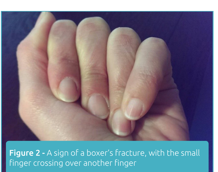 Hand showing a boxer's fracture with the small finger crossing under the ring finger, a sign of rotational deformity