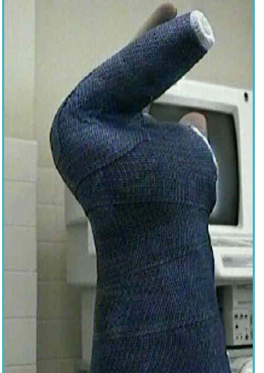 Hand in a cast worn after a boxer's fracture