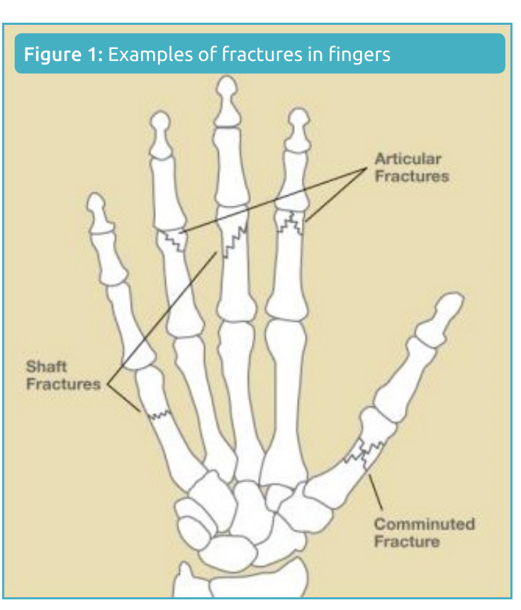 Illustration of examples of finger fractures, including shaft, articular, and comminuted fractures