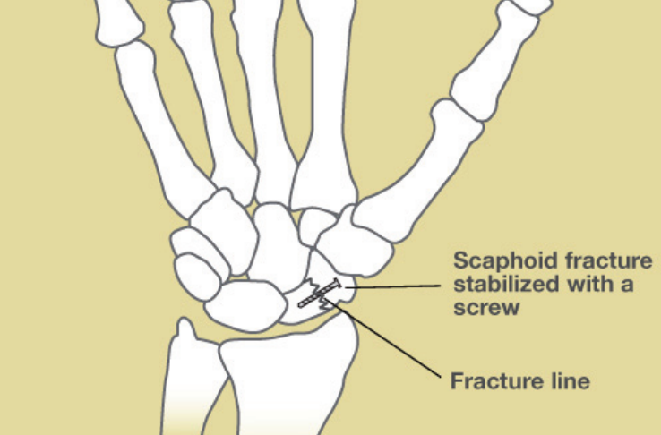Illustration of a scaphoid fracture stabilized with a single screw placed across the fracture line