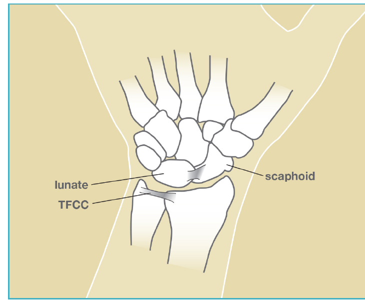 Illustration of the wrist showing the TFCC cartilage cushion on the small finger side of the wrist between the lunate, scaphoid, and ulna