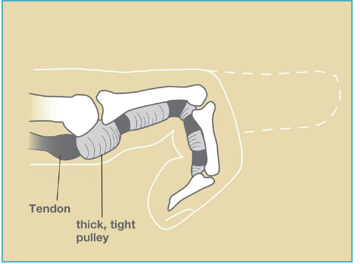 Finger locked in a bent position because the tendon cannot slide past the thickened pulley