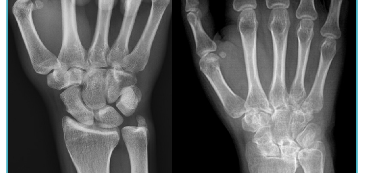 Two X-rays of arthritic wrists showing narrowed joint spaces and cartilage wear